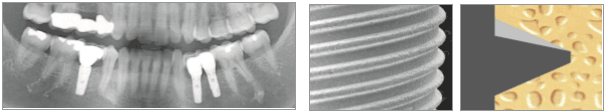images/Cleanlant-i-clean/i-clean-straight/Dentistry_Implant-i-clean-straight-3